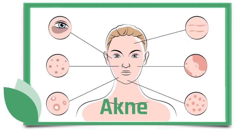 Akne und ihre Bekämpfung - Ernährung, Kräuter, Homöopathie